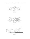 Clot Removal Device and Method of Using Same diagram and image