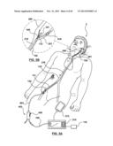 Endovascular Catheters and Methods for Carotid Body Ablation diagram and image