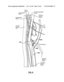 Endovascular Catheters and Methods for Carotid Body Ablation diagram and image