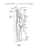 Endovascular Catheters and Methods for Carotid Body Ablation diagram and image