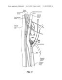 Endovascular Catheters and Methods for Carotid Body Ablation diagram and image