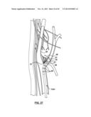 Endovascular Catheters and Methods for Carotid Body Ablation diagram and image