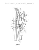 Endovascular Catheters and Methods for Carotid Body Ablation diagram and image