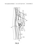 Endovascular Catheters and Methods for Carotid Body Ablation diagram and image