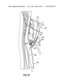 Endovascular Catheters and Methods for Carotid Body Ablation diagram and image