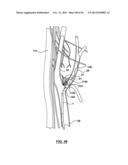 Endovascular Catheters and Methods for Carotid Body Ablation diagram and image