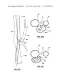 Endovascular Catheters and Methods for Carotid Body Ablation diagram and image