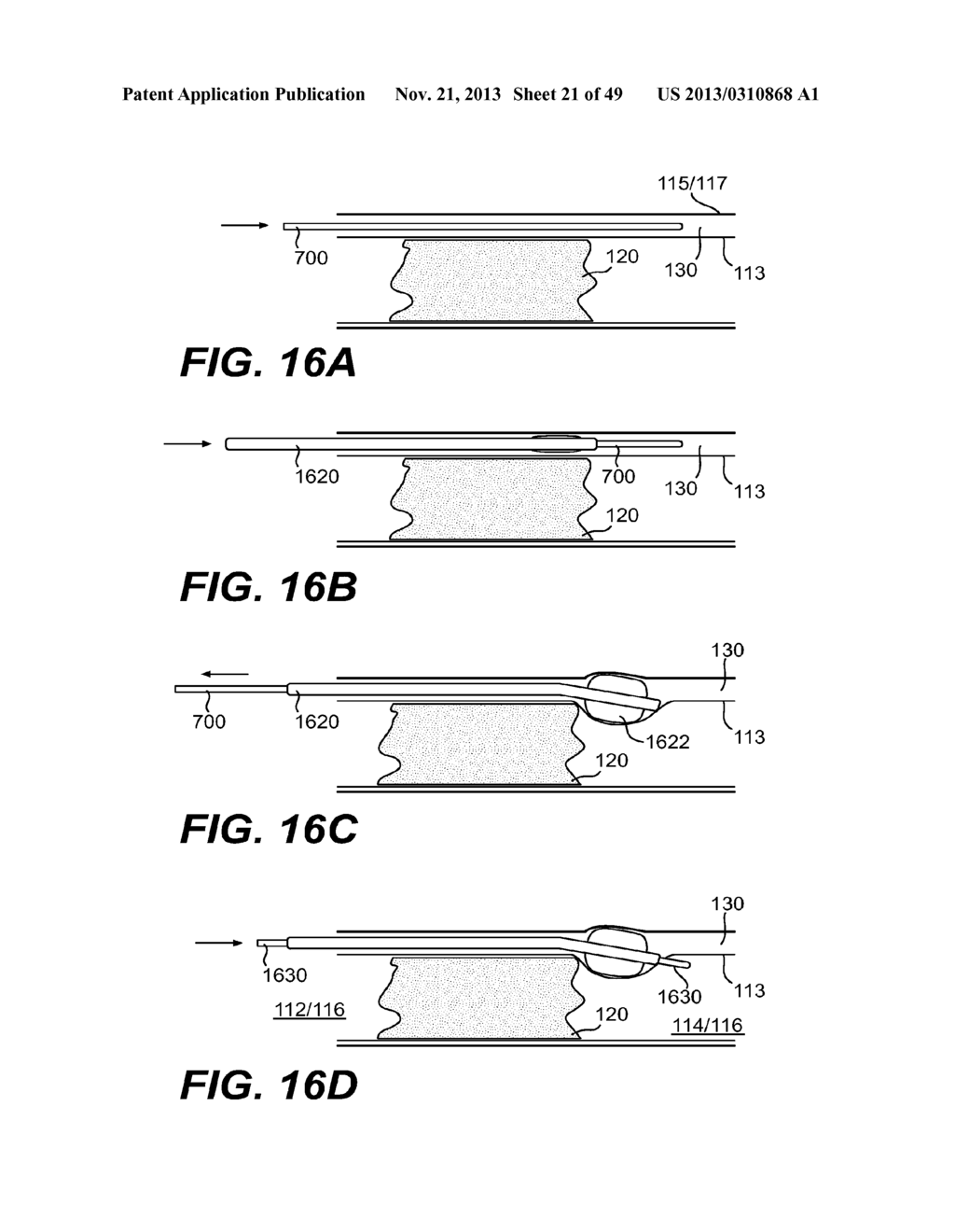 ENDOVASCULAR DEVICES AND METHODS FOR EXPLOITING INTRAMURAL SPACE - diagram, schematic, and image 22