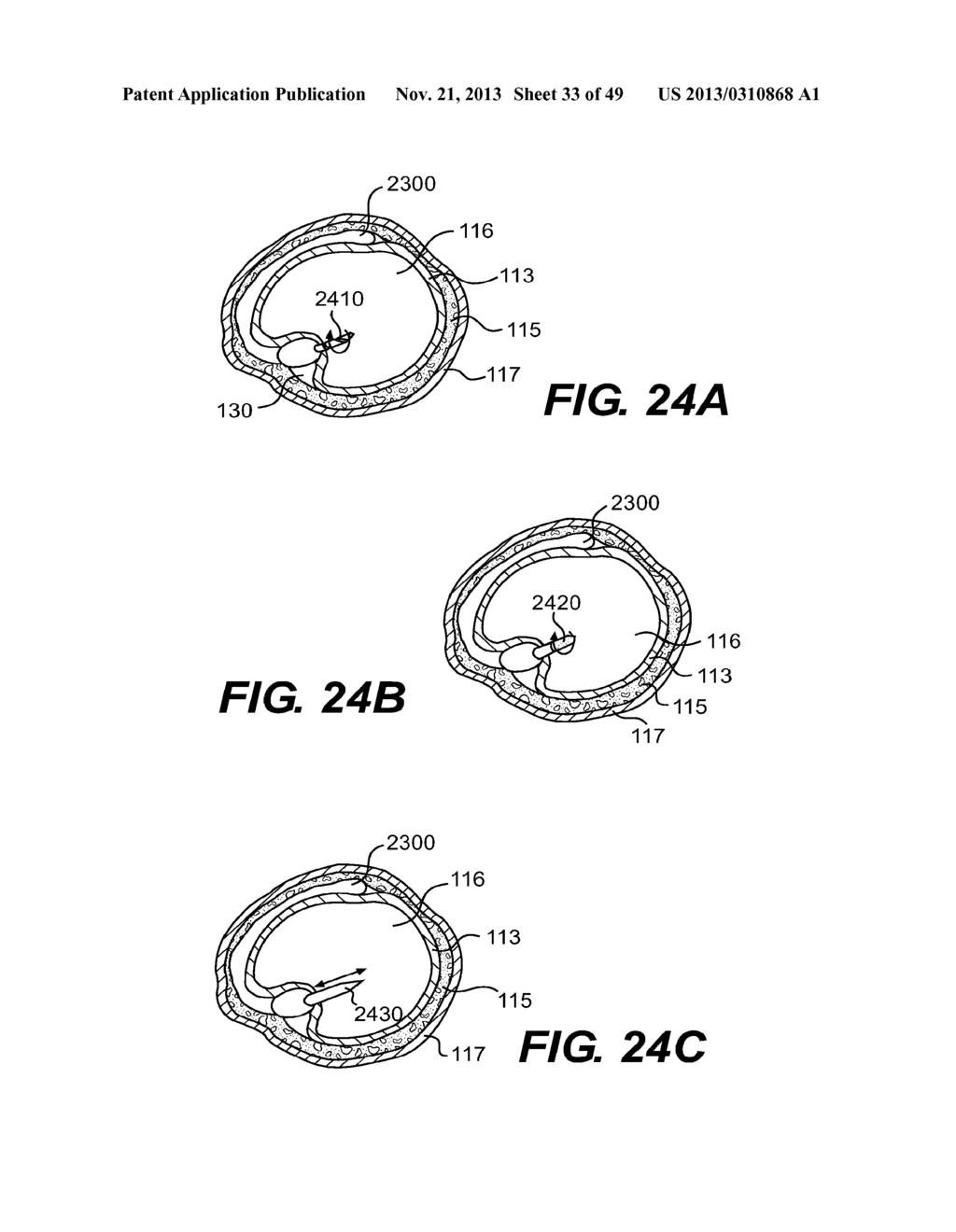 ENDOVASCULAR DEVICES AND METHODS FOR EXPLOITING INTRAMURAL SPACE - diagram, schematic, and image 34