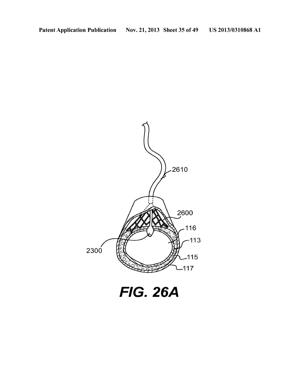 ENDOVASCULAR DEVICES AND METHODS FOR EXPLOITING INTRAMURAL SPACE - diagram, schematic, and image 36