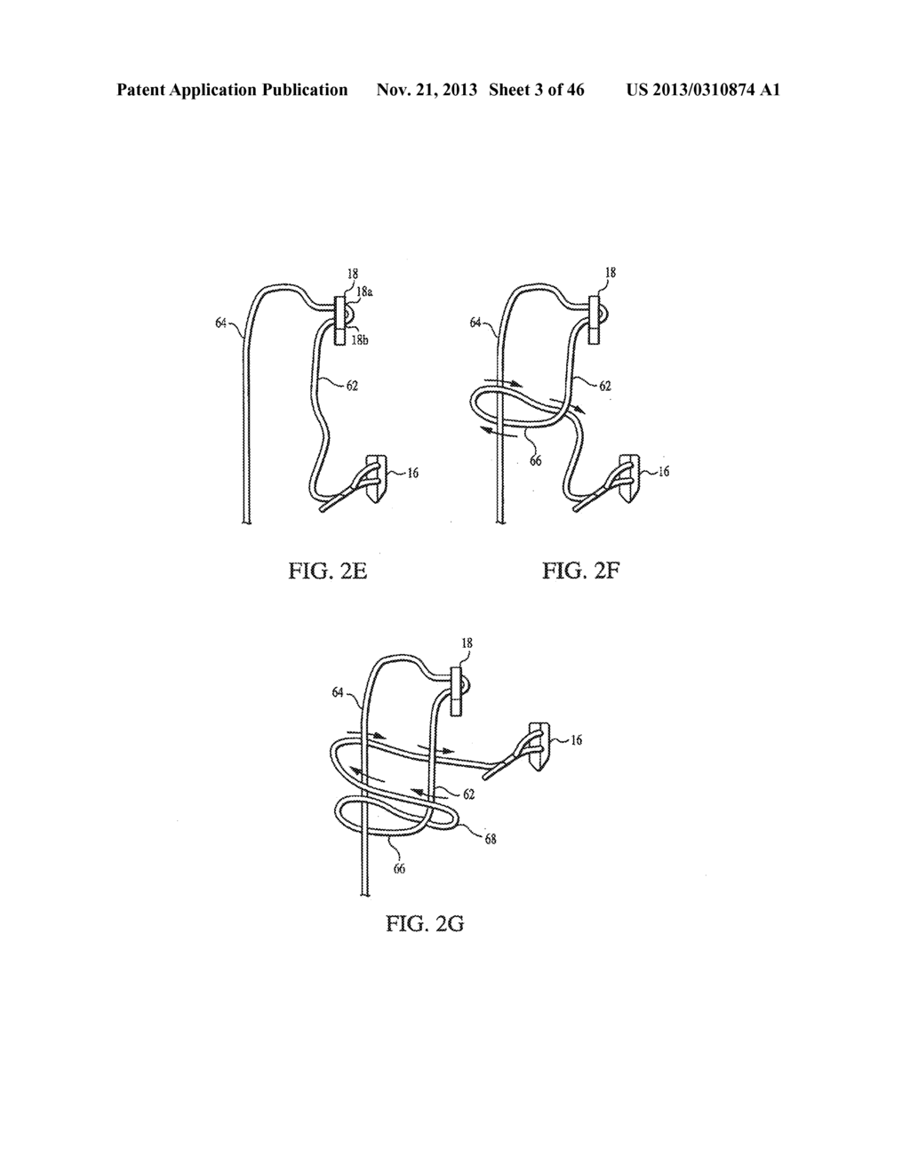 CLOSURE DEVICE AND METHOD FOR TISSUE REPAIR - diagram, schematic, and image 04