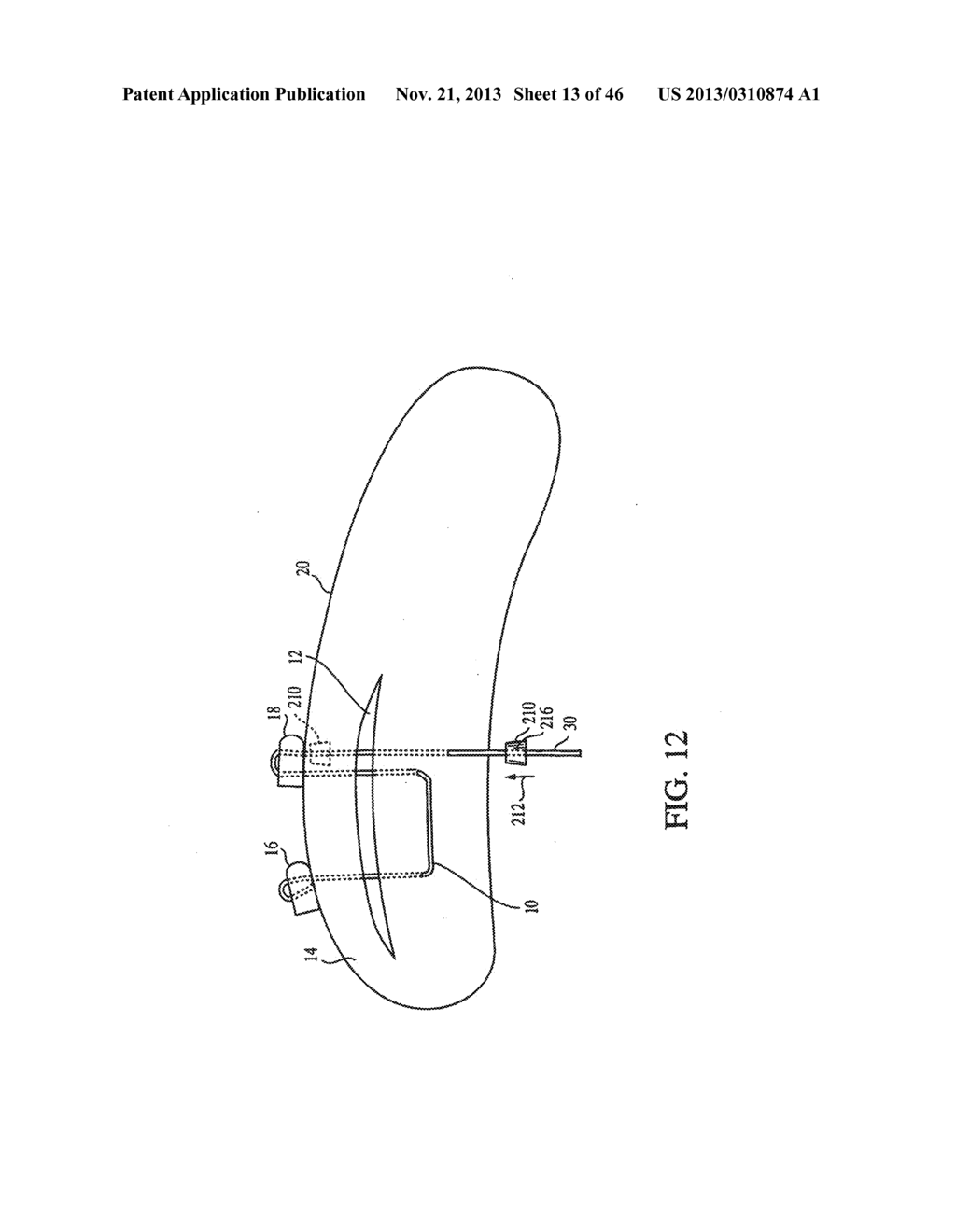 CLOSURE DEVICE AND METHOD FOR TISSUE REPAIR - diagram, schematic, and image 14