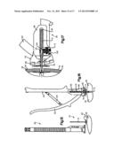 Securing Device To Secure Fixation Devices To Bone Portions diagram and image