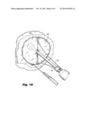 SYSTEMS AND METHODS FOR TREATING LUMENAL VALVES diagram and image