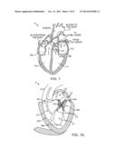 PROSTHETIC HEART VALVE DEVICES AND ASSOCIATED SYSTEMS AND METHODS diagram and image