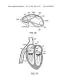 PROSTHETIC HEART VALVE DEVICES AND ASSOCIATED SYSTEMS AND METHODS diagram and image