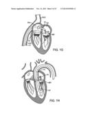 PROSTHETIC HEART VALVE DEVICES AND ASSOCIATED SYSTEMS AND METHODS diagram and image