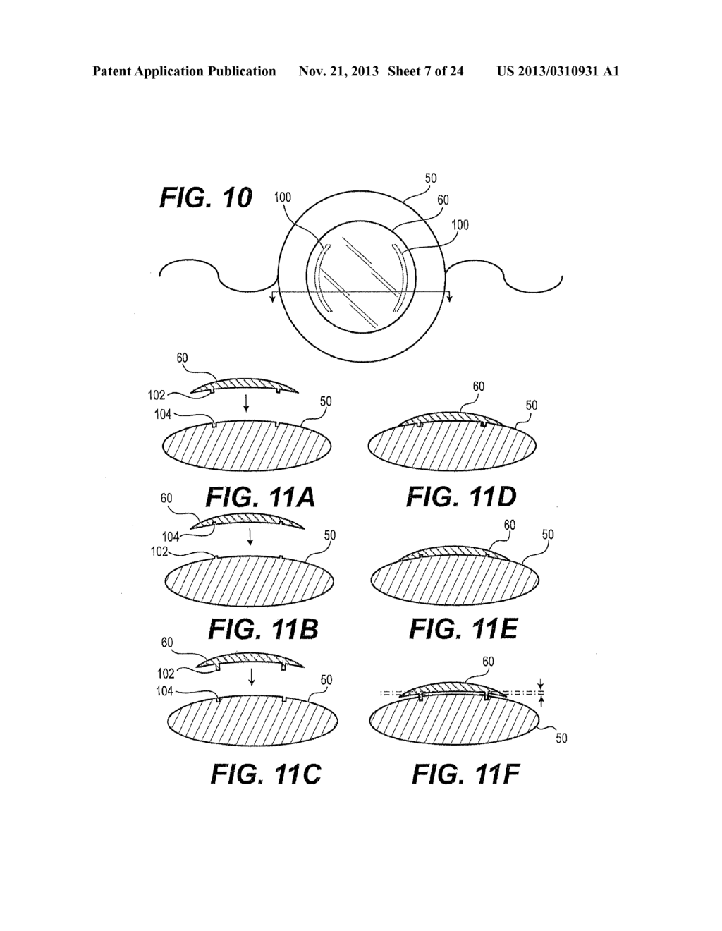 MODULAR INTRAOCULAR LENS DESIGNS AND METHODS - diagram, schematic, and image 08