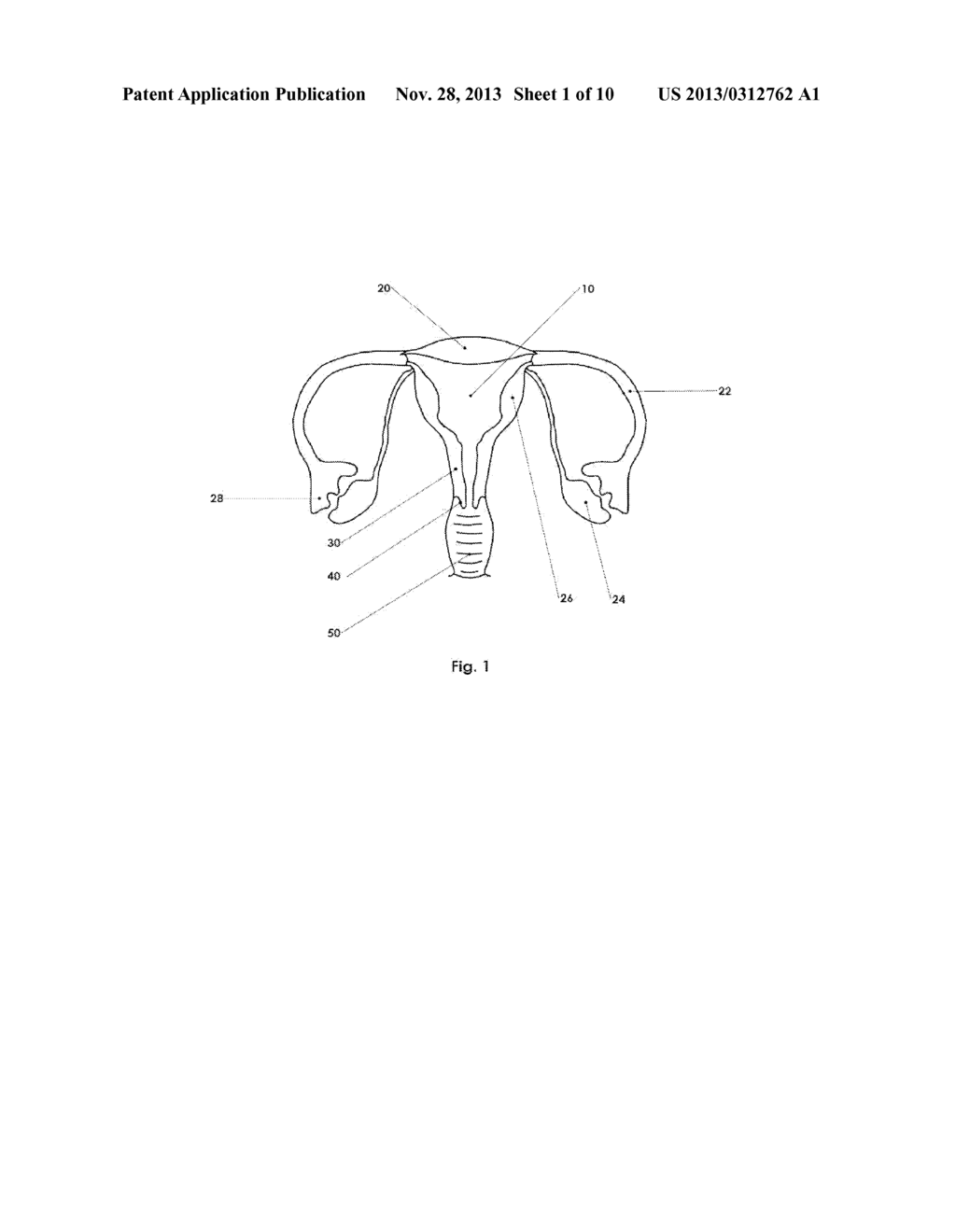 Reversible Acute Occlusion Implant, Delivery Catheter and Method - diagram, schematic, and image 02