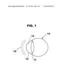 SOFT CONTACT LENSES FOR TREATING AMETROPIA diagram and image