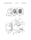 METHOD FOR NON-INVASIVE TREATMENT OF CEREBRAL ANEURYSMS diagram and image