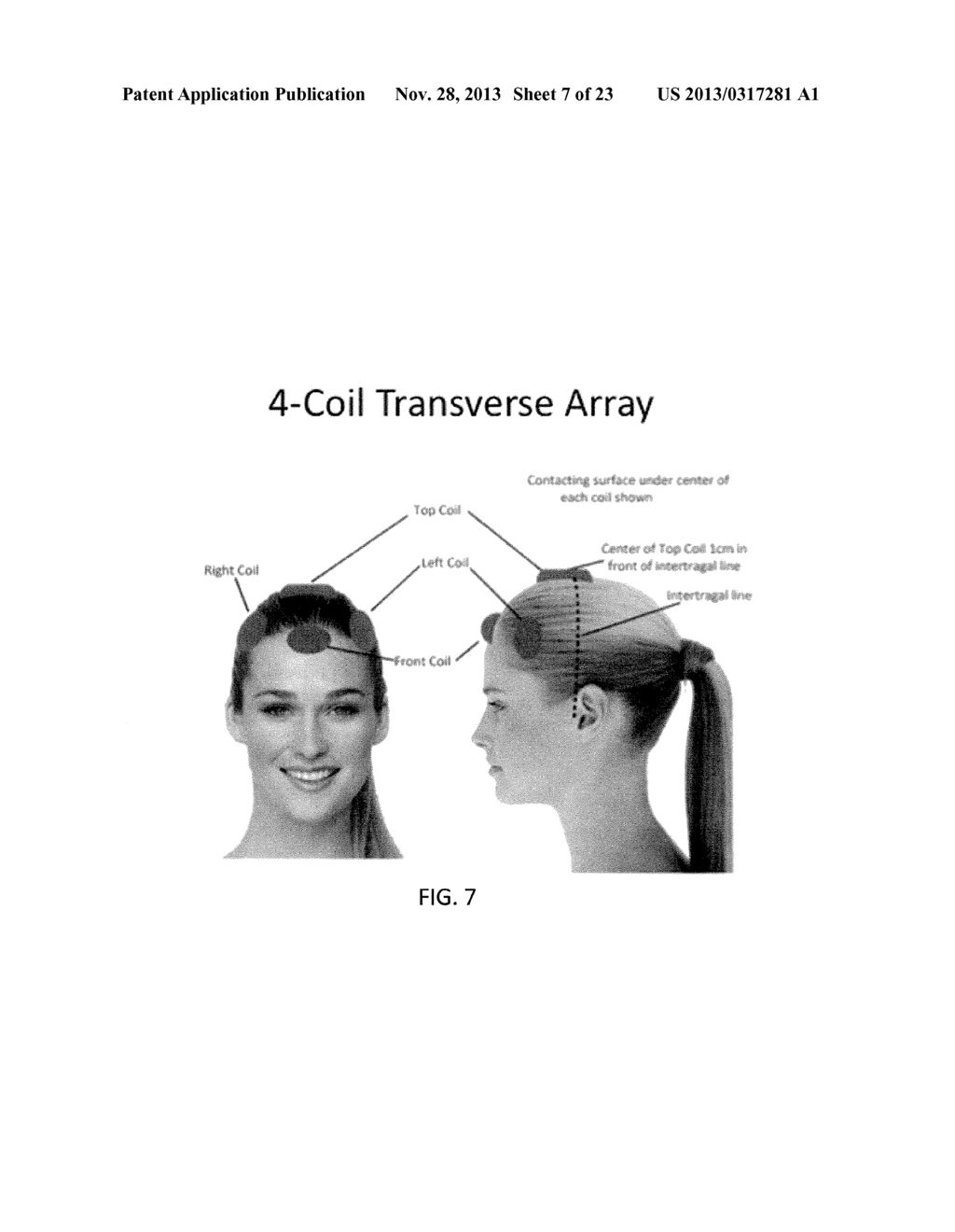 TRANSCRANIAL MAGNETIC STIMULATION FOR IMPROVED ANALGESIA - diagram, schematic, and image 08