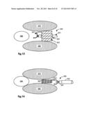 RETRACTION OF TISSUE FOR SINGLE PORT ENTRY, ROBOTICALLY ASSISTED MEDICAL     PROCEDURES diagram and image