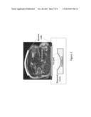 TARGETED DELIVERY OF ACTIVE AGENTS USING THERMALLY STIMULATED LARGE     INCREASE OF PERFUSION BY HIGH INTENSITY FOCUSED ULTRASOUND diagram and image