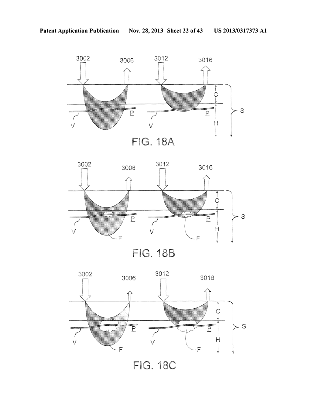 System for Mitigating the Effects of Tissue Blood Volume Changes to Aid in     Diagnosing Infiltration or Extravasation in Animalia Tissue - diagram, schematic, and image 23