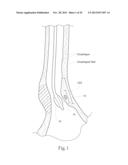 GERD TREATMENT APPARATUS AND METHOD diagram and image