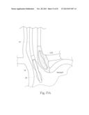 GERD TREATMENT APPARATUS AND METHOD diagram and image