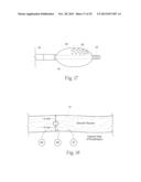 GERD TREATMENT APPARATUS AND METHOD diagram and image