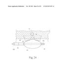 GERD TREATMENT APPARATUS AND METHOD diagram and image