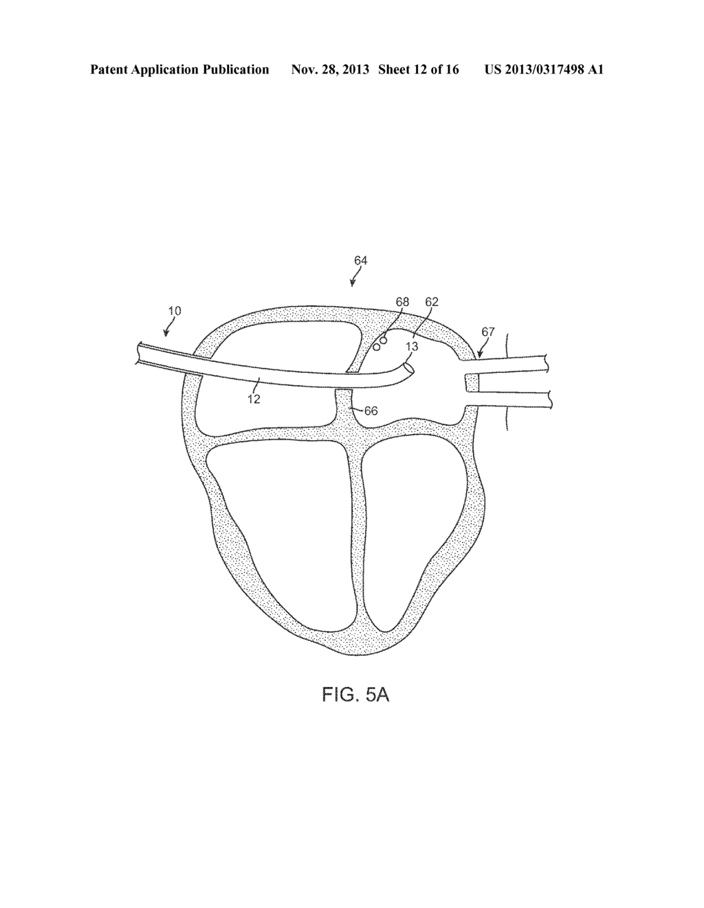 ASYMMETRIC DUAL DIRECTIONAL STEERABLE CATHETER SHEATH - diagram, schematic, and image 13