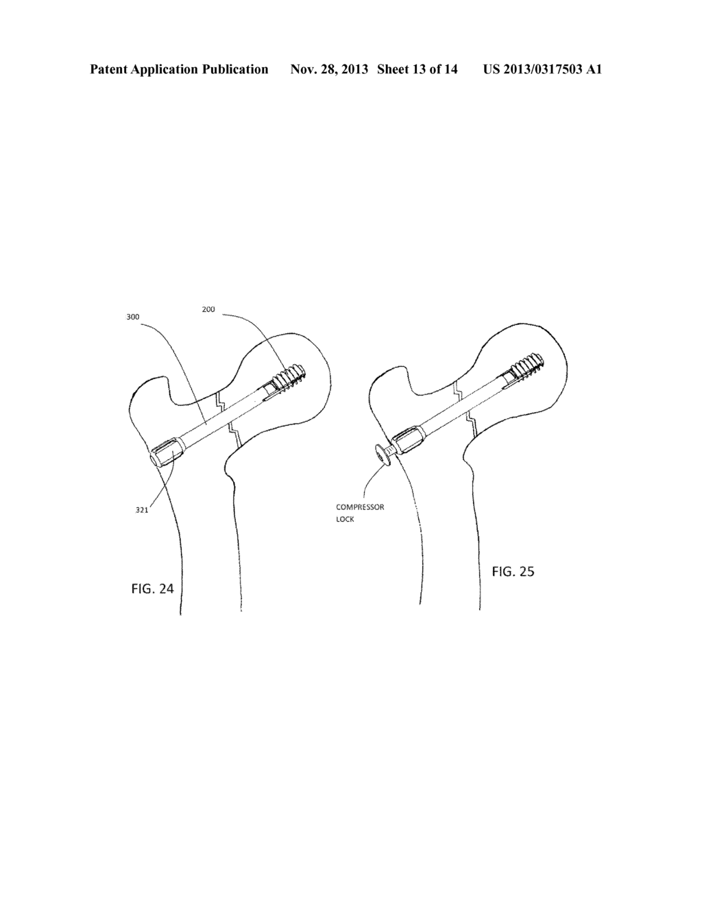 BONE FIXATION SCREW AND METHOD - diagram, schematic, and image 14