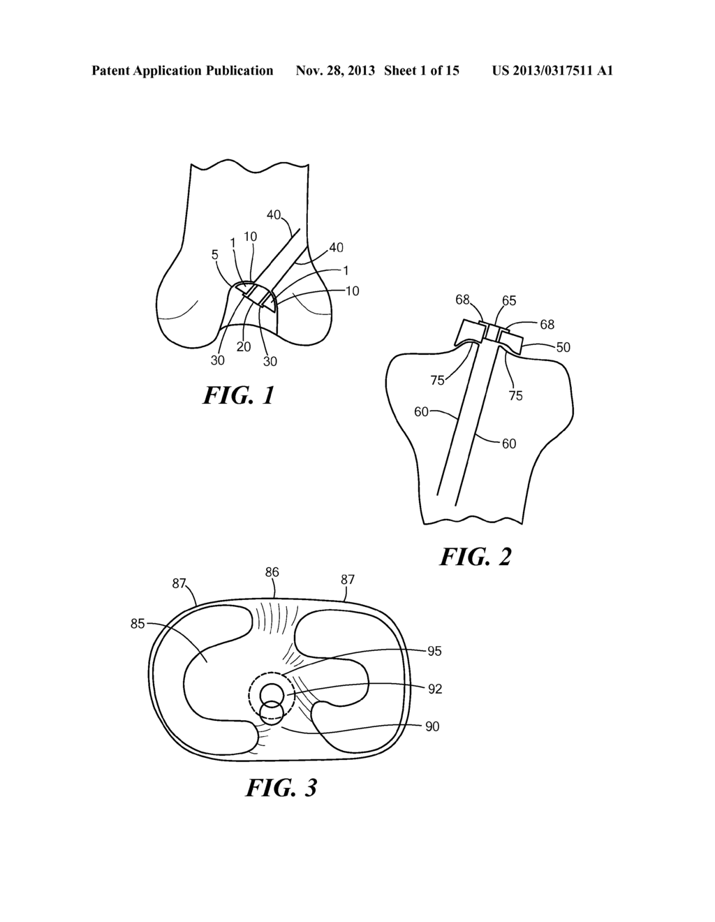 PATIENT-SPECIFIC JOINT ARTHROPLASTY DEVICES FOR LIGAMENT REPAIR - diagram, schematic, and image 02