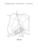 PATIENT-SPECIFIC JOINT ARTHROPLASTY DEVICES FOR LIGAMENT REPAIR diagram and image