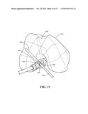 PATIENT-SPECIFIC JOINT ARTHROPLASTY DEVICES FOR LIGAMENT REPAIR diagram and image