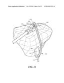 PATIENT-SPECIFIC JOINT ARTHROPLASTY DEVICES FOR LIGAMENT REPAIR diagram and image