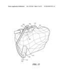 PATIENT-SPECIFIC JOINT ARTHROPLASTY DEVICES FOR LIGAMENT REPAIR diagram and image