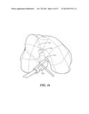 PATIENT-SPECIFIC JOINT ARTHROPLASTY DEVICES FOR LIGAMENT REPAIR diagram and image