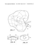 PATIENT-SPECIFIC JOINT ARTHROPLASTY DEVICES FOR LIGAMENT REPAIR diagram and image