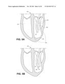 RETRIEVABLE CARDIAC DEVICES diagram and image