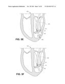 RETRIEVABLE CARDIAC DEVICES diagram and image