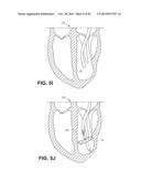 RETRIEVABLE CARDIAC DEVICES diagram and image