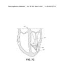 RETRIEVABLE CARDIAC DEVICES diagram and image