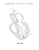 RETRIEVABLE CARDIAC DEVICES diagram and image