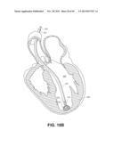 RETRIEVABLE CARDIAC DEVICES diagram and image