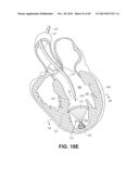 RETRIEVABLE CARDIAC DEVICES diagram and image