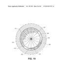 RETRIEVABLE CARDIAC DEVICES diagram and image